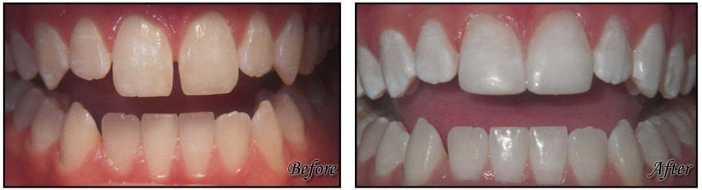 Composite Resin Bonding - Fairfax Cosmetic Dentistry