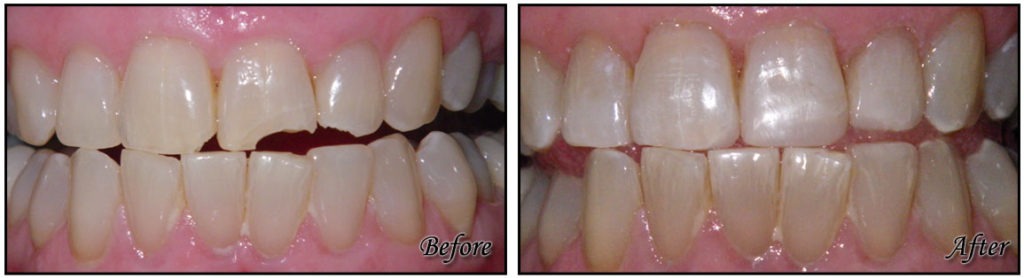 Composite Resin Bonding - Fairfax Cosmetic Dentistry