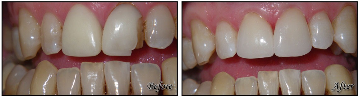 Ceramic Dental Crowns