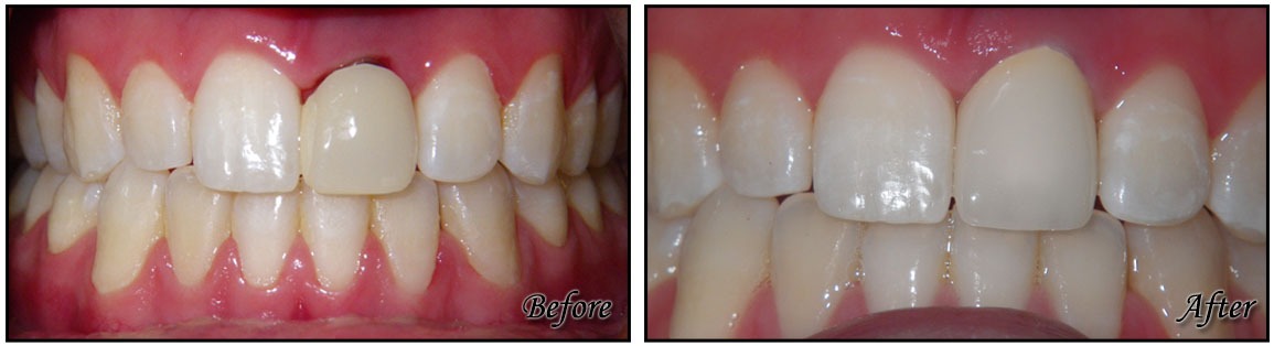 Implant Crowns