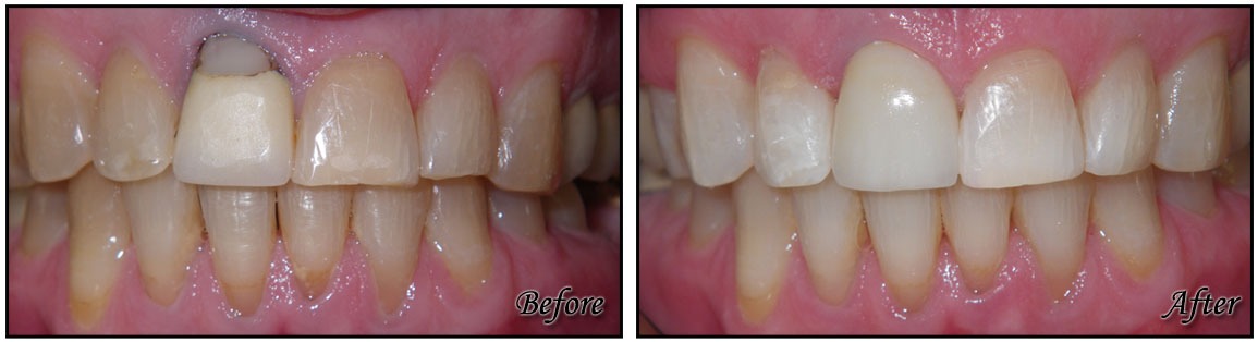 Implant Crowns