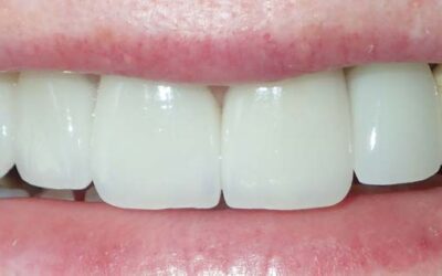 All Ceramic Dental Crowns